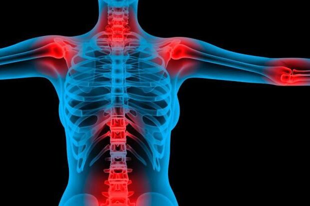 Fibromialgia, la legge fantasma del 2019: l'accusa di Coros de Fibro alla Regione. "Sette anni di attesa e solo silenzi"