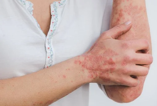 La vita che ci piace: i pazienti psoriasici ci mettono la faccia