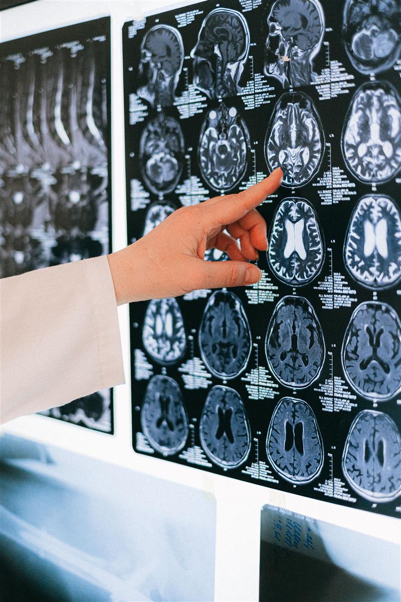 Sassari, all'Aou le nuove terapie contro l'emicrania: il 2 ottobre il congresso al Complesso Biomedico